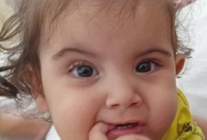Conjoined Girl Dies After Operation To Separate Sisters